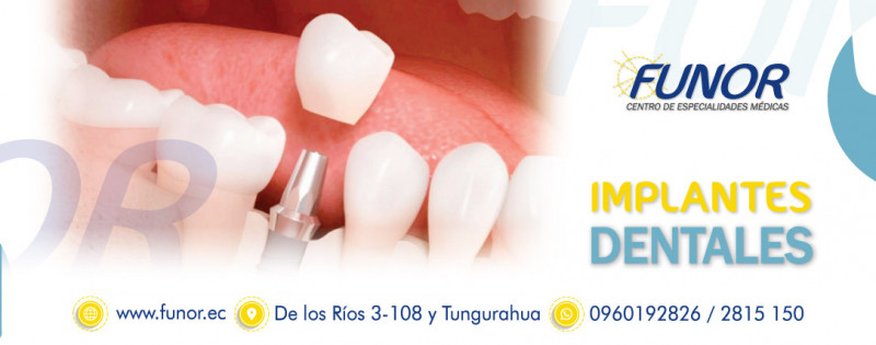 Implantes Dentales 